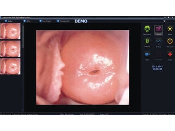 SOFTWARE per VIDEO COLPOSCOPIO A LED CON TELECAMERA INTEGRATA - e per braccio ad L